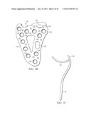 System for Treating Bone Fractures diagram and image