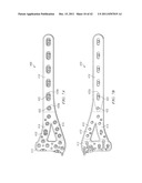 System for Treating Bone Fractures diagram and image