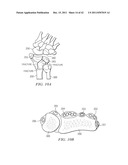 System for Treating Bone Fractures diagram and image