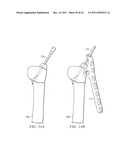 System for Treating Bone Fractures diagram and image