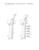 System for Treating Bone Fractures diagram and image