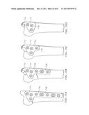 System for Treating Bone Fractures diagram and image