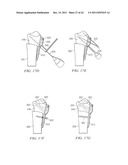 System for Treating Bone Fractures diagram and image