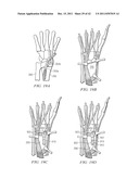 System for Treating Bone Fractures diagram and image