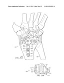 System for Treating Bone Fractures diagram and image