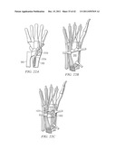 System for Treating Bone Fractures diagram and image