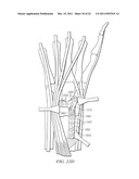 System for Treating Bone Fractures diagram and image