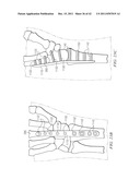 System for Treating Bone Fractures diagram and image