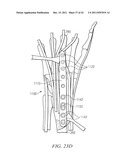 System for Treating Bone Fractures diagram and image