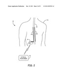 PROGRAMMING TECHNIQUES FOR CONTROLLING RATE OF CHANGE OF ELECTRICAL     STIMULATION THERAPY diagram and image