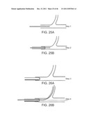 METHODS AND SYSTEMS FOR OSTIAL STENTING OF A BIFURCATION diagram and image