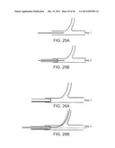 METHODS AND SYSTEMS FOR TREATING A BIFURCATION WITH PROVISIONAL SIDE     BRANCH STENTING diagram and image