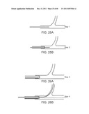 SELECTIVE STENT CRIMPING diagram and image