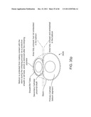 SELECTIVE STENT CRIMPING diagram and image