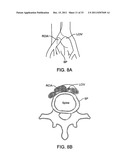 BI-DIRECTIONAL STENT DELIVERY SYSTEM diagram and image