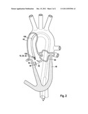 MEDICAL VALVE IMPLANT FOR IMPLANTATION IN AN ANIMAL BODY AND/OR HUMAN BODY diagram and image