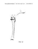 TRIAL FEMORAL PROSTHESIS AND ITS USE diagram and image