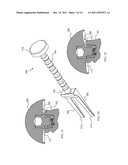 Joint Prosthesis with Positionable Head diagram and image