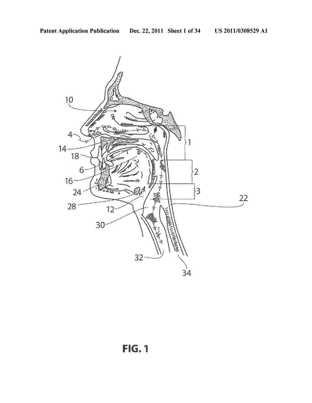 SYSTEMS AND METHODS FOR TREATMENT OF SLEEP APNEA - diagram, schematic, and image 02