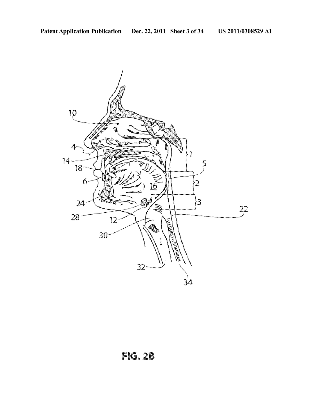 SYSTEMS AND METHODS FOR TREATMENT OF SLEEP APNEA - diagram, schematic, and image 04