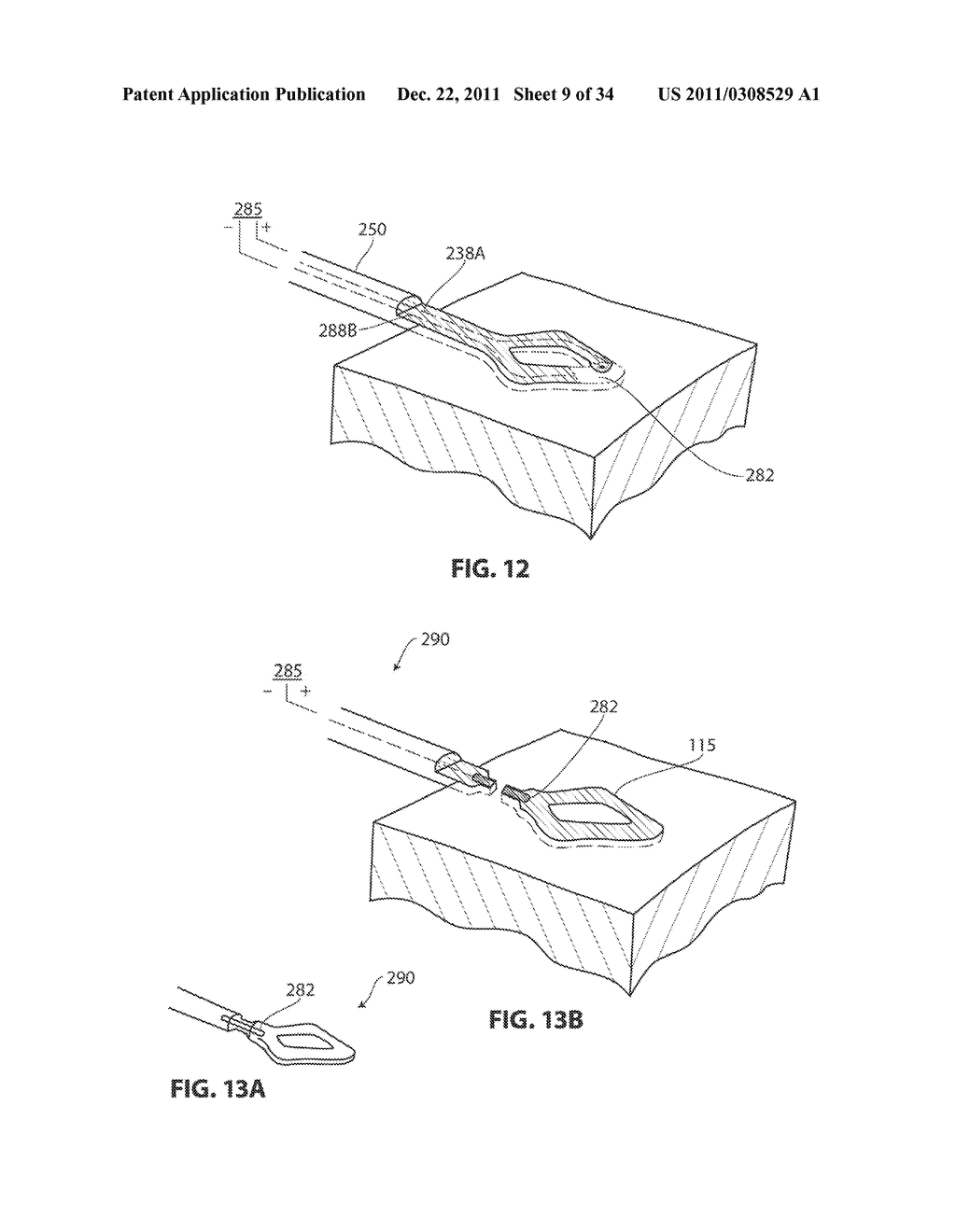 SYSTEMS AND METHODS FOR TREATMENT OF SLEEP APNEA - diagram, schematic, and image 10