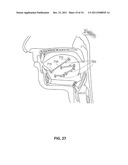 SYSTEMS AND METHODS FOR TREATMENT OF SLEEP APNEA diagram and image