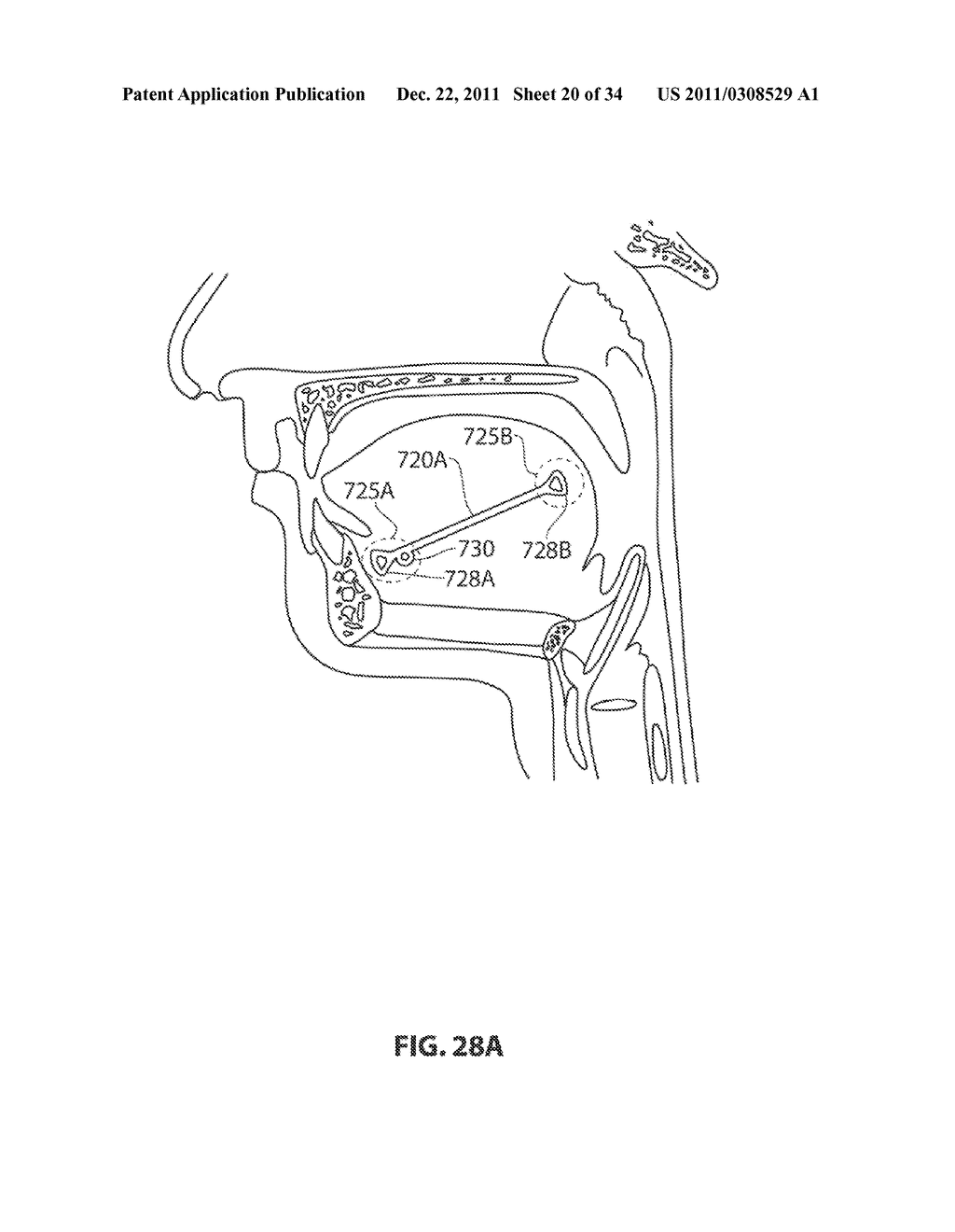 SYSTEMS AND METHODS FOR TREATMENT OF SLEEP APNEA - diagram, schematic, and image 21