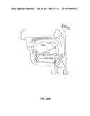 SYSTEMS AND METHODS FOR TREATMENT OF SLEEP APNEA diagram and image