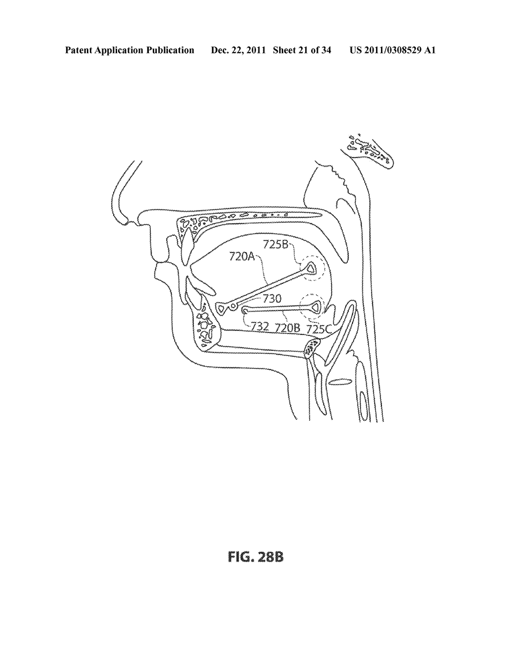 SYSTEMS AND METHODS FOR TREATMENT OF SLEEP APNEA - diagram, schematic, and image 22