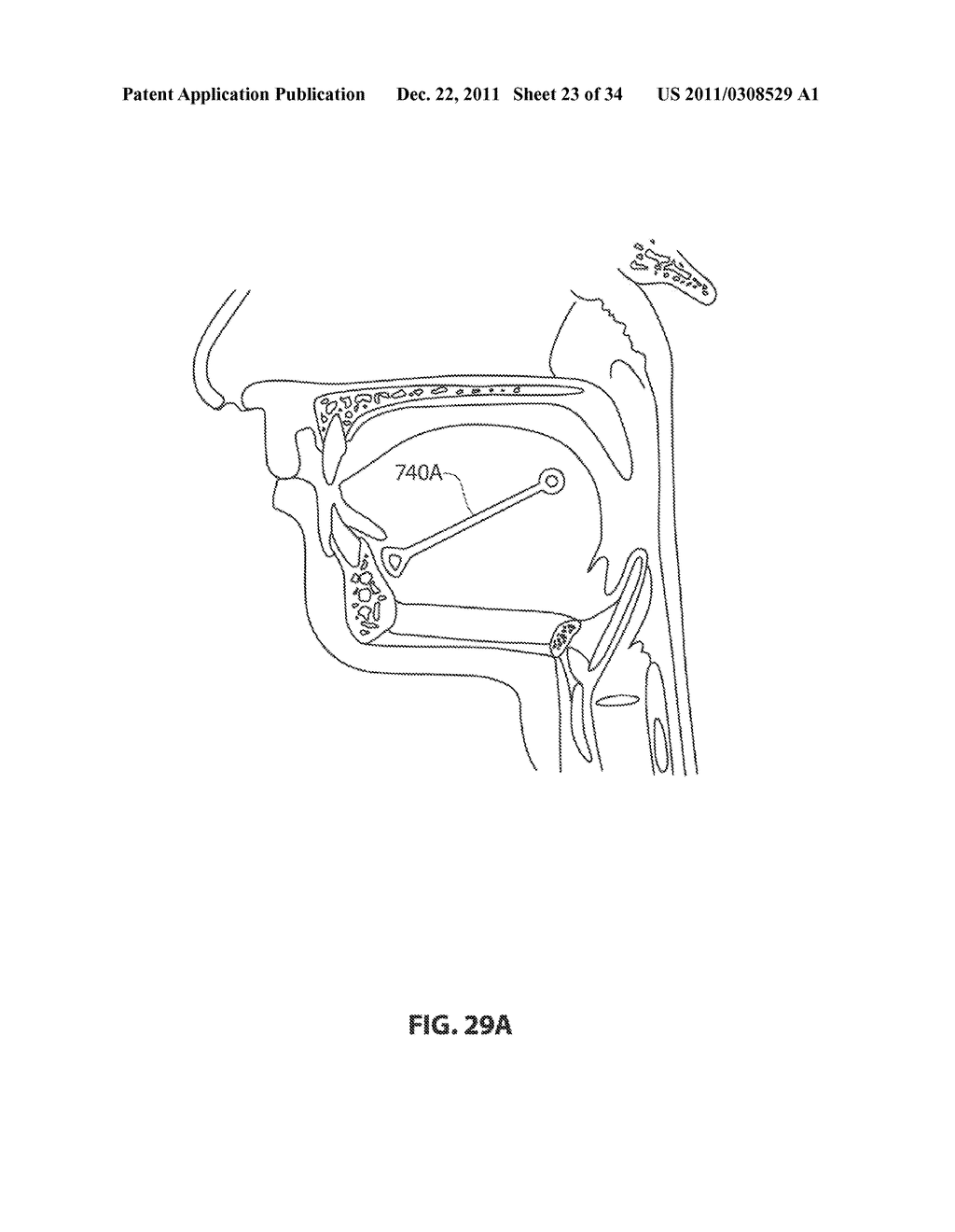 SYSTEMS AND METHODS FOR TREATMENT OF SLEEP APNEA - diagram, schematic, and image 24