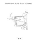 SYSTEMS AND METHODS FOR TREATMENT OF SLEEP APNEA diagram and image