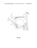 SYSTEMS AND METHODS FOR TREATMENT OF SLEEP APNEA diagram and image