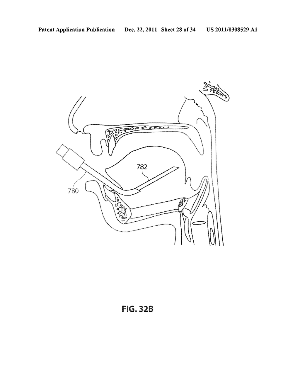 SYSTEMS AND METHODS FOR TREATMENT OF SLEEP APNEA - diagram, schematic, and image 29