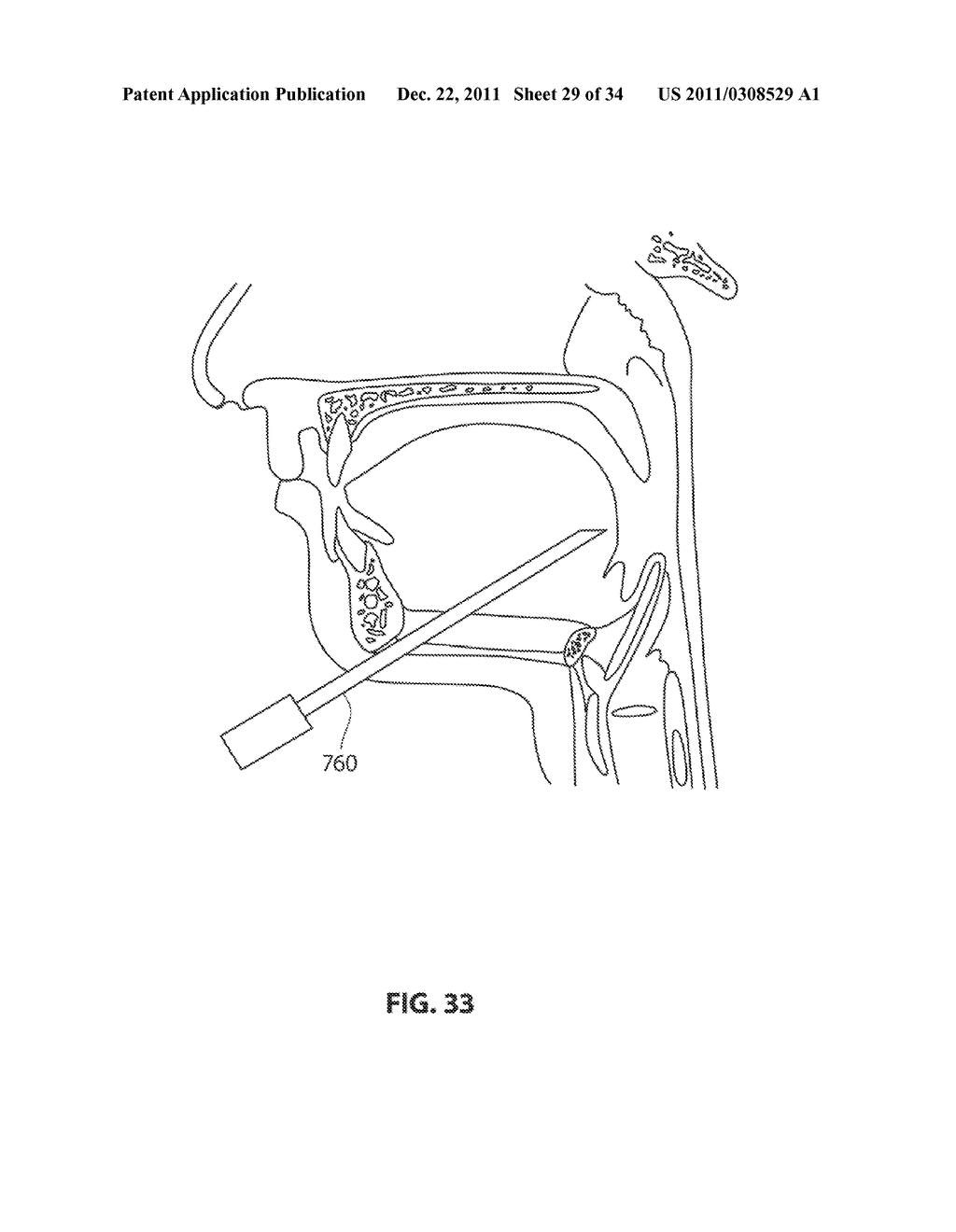 SYSTEMS AND METHODS FOR TREATMENT OF SLEEP APNEA - diagram, schematic, and image 30