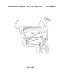 SYSTEMS AND METHODS FOR TREATMENT OF SLEEP APNEA diagram and image