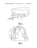 Apparatus for Clamping on the Lower or Upper Teeth, and Activator     Comprising Such an Apparatus diagram and image