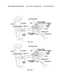RECEIVER ASSEMBLY FOR AN INFLATABLE EAR DEVICE diagram and image