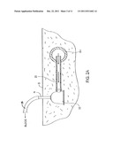 TRANSDERMAL VENOUS ACCESS LOCKING SOLUTIONS diagram and image