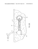 TRANSDERMAL VENOUS ACCESS LOCKING SOLUTIONS diagram and image