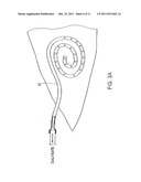 TRANSDERMAL VENOUS ACCESS LOCKING SOLUTIONS diagram and image