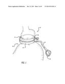 FLOW RESTRICTOR AND METHOD FOR AUTOMATICALLY CONTROLLING PRESSURE FOR A     GASTRIC BAND diagram and image