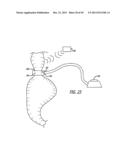 FLOW RESTRICTOR AND METHOD FOR AUTOMATICALLY CONTROLLING PRESSURE FOR A     GASTRIC BAND diagram and image