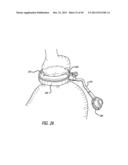 FLOW RESTRICTOR AND METHOD FOR AUTOMATICALLY CONTROLLING PRESSURE FOR A     GASTRIC BAND diagram and image