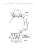 FLOW RESTRICTOR AND METHOD FOR AUTOMATICALLY CONTROLLING PRESSURE FOR A     GASTRIC BAND diagram and image