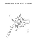 SURGICAL METHODS AND SURGICAL KITS diagram and image