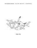 SURGICAL METHODS AND SURGICAL KITS diagram and image