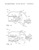 LAPAROSCOPIC SUTURE DEVICE WITH ASYNCHRONOUS IN-LINE NEEDLE MOVEMENT diagram and image