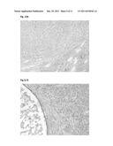 Tumor Treatment diagram and image