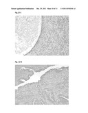 Tumor Treatment diagram and image