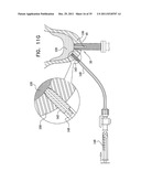 DENTAL IMPLANT HAVING A RECESSED SURFACE FOR SEALING diagram and image